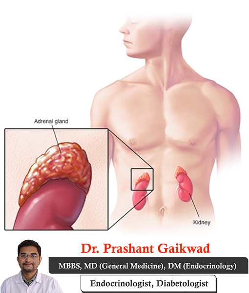 dr-prashant-gaikwad-adrenal-gland-disorders-consultant