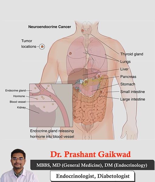 dr-prashant-gaikwad-management-of-neuroendocrine-tumors-consultant